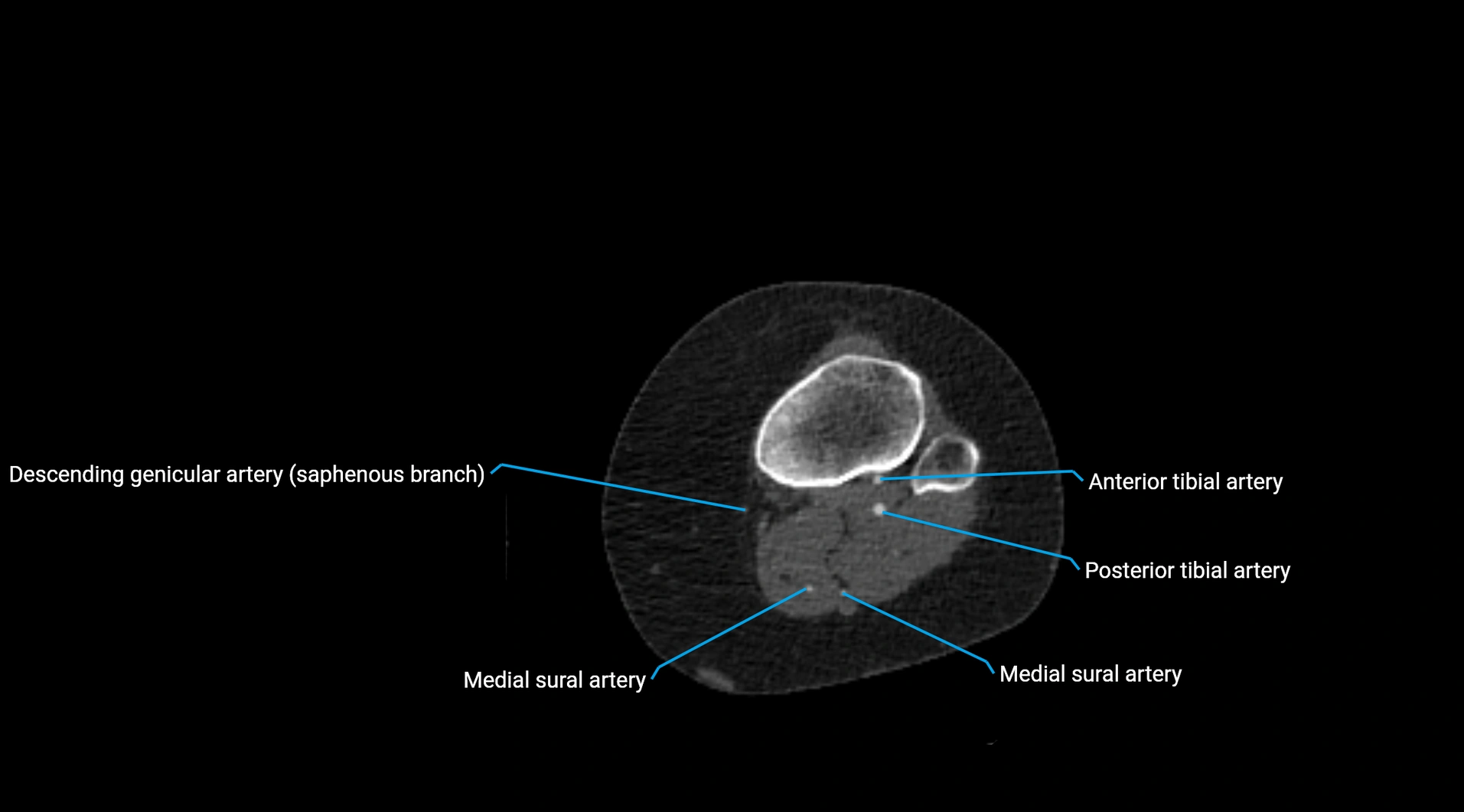 CTA lower limb cross sectional anatomy labelled image _182.webp
